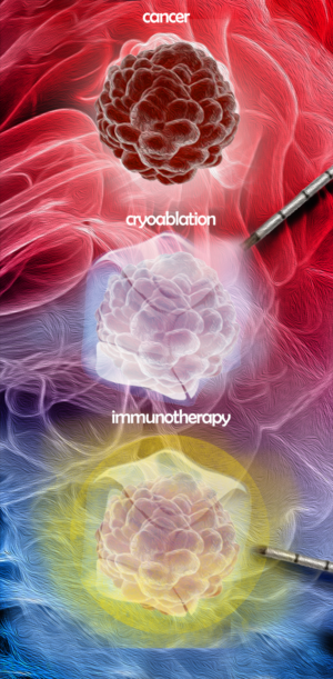 Combined Cryoablation of cancer with injection of immunotherapy | Illustration Design by smiledim24