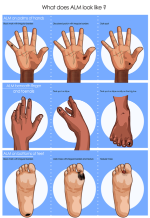 Cancer Researchers need illustrations to help people identify rare skin cancer | Diseño Con Ilustración por smiledim24
