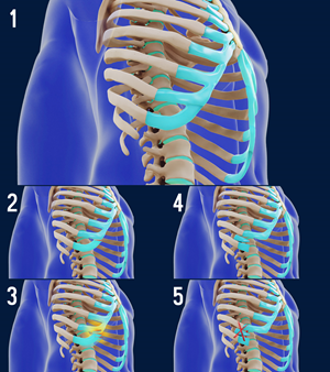 Visualization of surgery for slipping rib syndrome